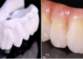 ZENOSTAR臻瓷：革新冠桥修复技术，守护您的牙齿健康